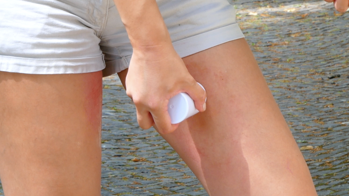 Soothe Chafed Thighs